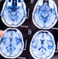 Zaujalo nás. Hladina lítia v mozgu pacientov s Alzheimerom je nižšia o 60%. Môže táto zabudnutá živina zvrátiť demenciu?
